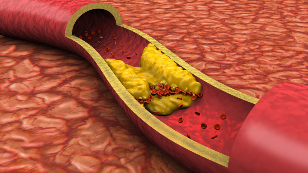 Scopri i benefici della dieta su misura per patologie croniche come diabete, colesterolo alto e intolleranze alimentari. Approccio nutrizionale personalizzato per migliorare la salute e prevenire complicazioni.