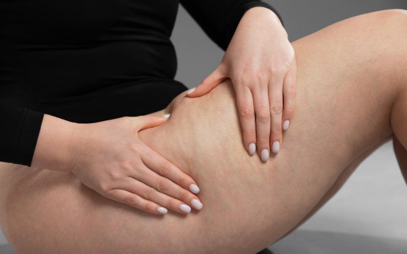 Trattamento di carbossiterapia per la cellulite presso centro medico a Milano